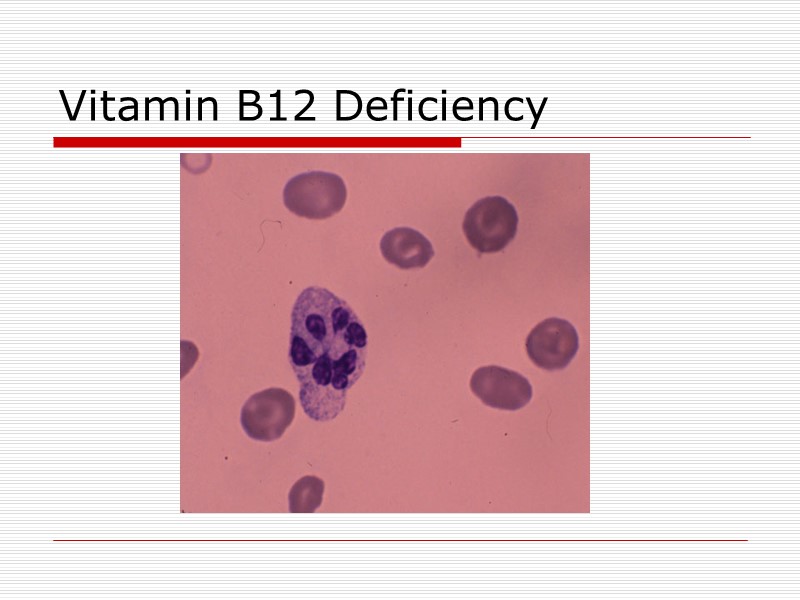 Vitamin B12 Deficiency